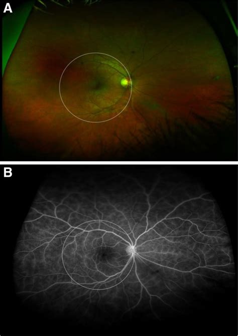 Ultra Wide Field Retinal Imaging In The Management Of Non Infectious