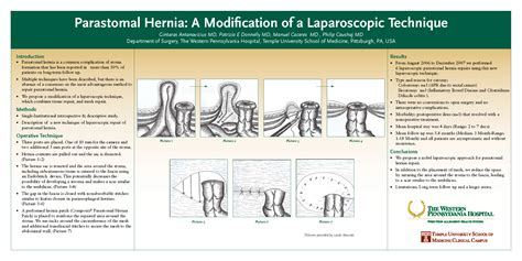 Parastomal Hernia A Modification Of A Laparoscopic Technique Sages