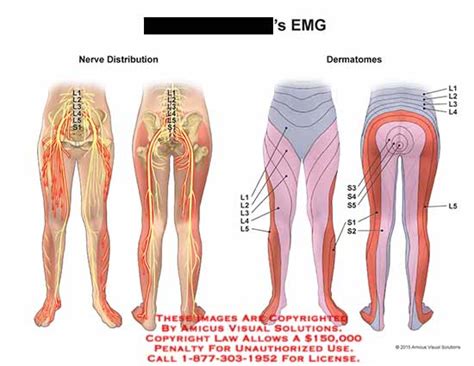 AMICUS Illustration Of Amicus Injury EMG Nerve Distribution L1 L2 L3 L4