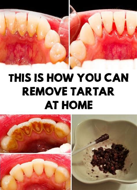 how to remove tartar from teeth diy howtoremvo