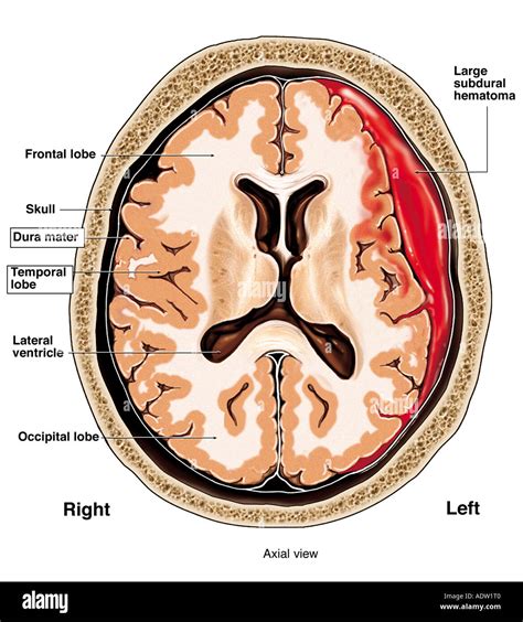 Brain Hemorrhage Deutsch Overview Of Coma And Impaired Consciousness