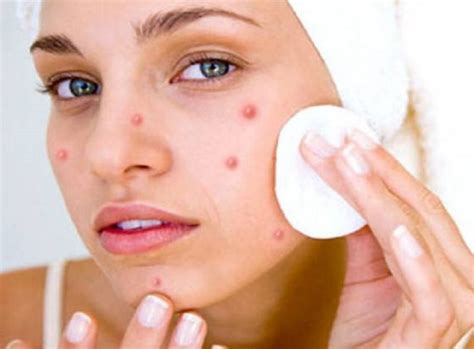 Most Common Causes And Different Types Of Pimples Healthy Flat