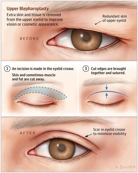 Upper Eyelid Blepharoplasty Coleman Eye Center