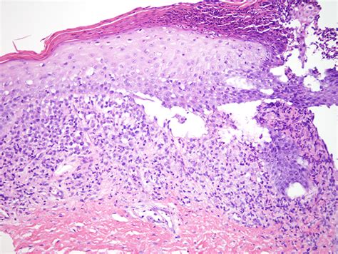 Langerhans Cell Histiocytosis Dermatopathology