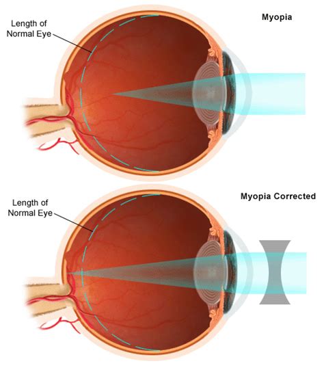 Myopia Nearsightedness Boston Childrens Hospital