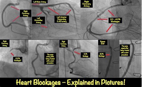 Heart Blockage Explained With Pictures • Myheart