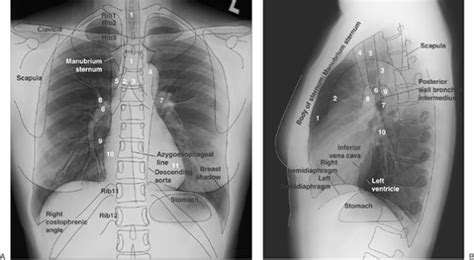 Normal Anatomy Of Chest X Ray File Mediastinal Structures On Chest X Ray Annotated