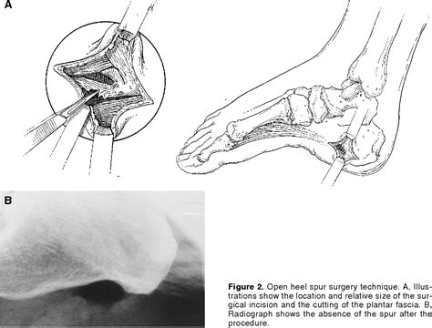 Figure 2 From Long Term Follow Up Of Heel Spur Surgery Semantic Scholar