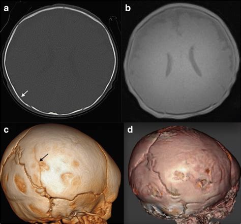 A 4 Month Old Female With Isolated Right Parietal Skull Fracture
