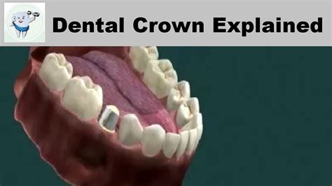 Types Of Dental Crowns Dental Crown Explained Youtube