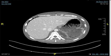 Ct Chest Axial View Showing Splenic Abscess Invading The Stomach