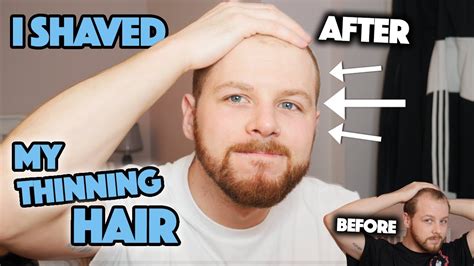 Going Bald In My 20 S So I Shaved My Head Youtube
