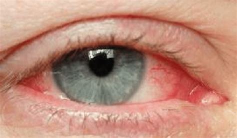Viral Conjunctivitis Look For Pink Eye Without Any Discharge