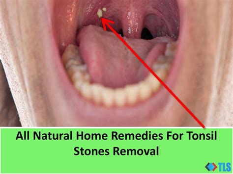 All Natural Home Remedies For Tonsil Stones Removal By The Life Square