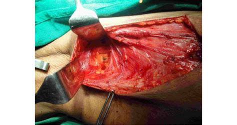 Intra Operative Picture Showing The Axilla After Lymph Node Dissection