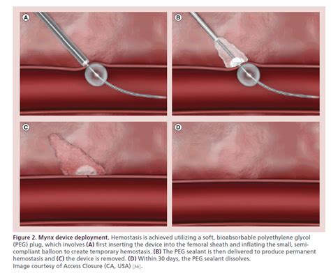 Femoral Arteriotomy Closure Using The Mynx Vascular Closure Devic