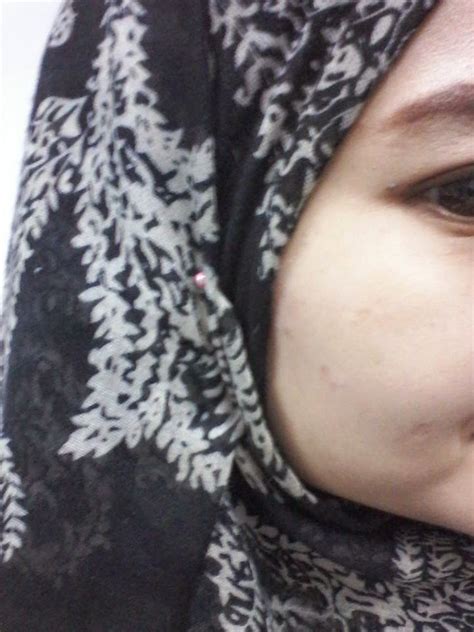 Kulit berjerawat atau ada bekas jerawat. Cik Putri: Review / Testimoni : Nour Ain Skin Care , Bio ...