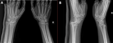 Cureus Volar Radiocarpal Dislocation A Case Report And Review Of