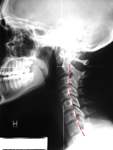 I Have A Reverse Cervical Curve Is This A Problem Can You Fix It