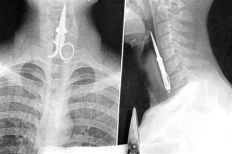 Incredible X Ray Of Scissors Stuck In Man S Throat Plus More Pics Of