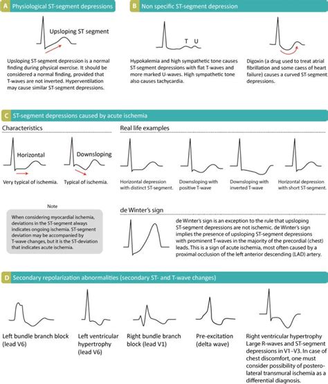 Ecg Interpretation Characteristics Of The Normal Ecg P Wave Qrs Complex