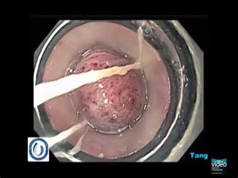Ligation Of Esophageal Varices Video Medtube Net My XXX Hot Girl
