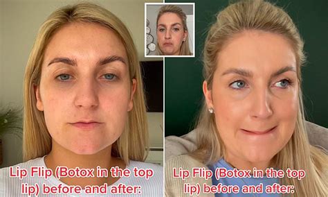 Woman Opens Up About Her Botox Lip Flip Which She Says Left Her Struggling To Drink Daily