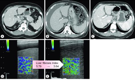 Dynamic Contrast Enhanced Computed Tomography Ct Images In The Portal