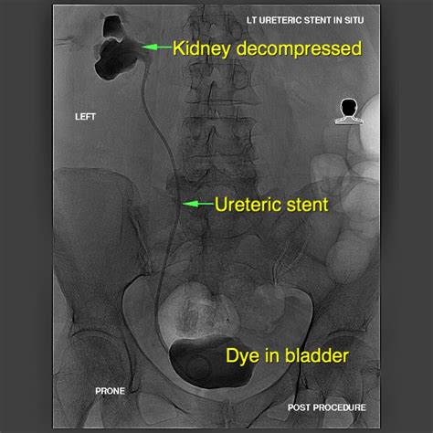 Nephrostomy And Ureteric Stent Sydney Medical Interventions