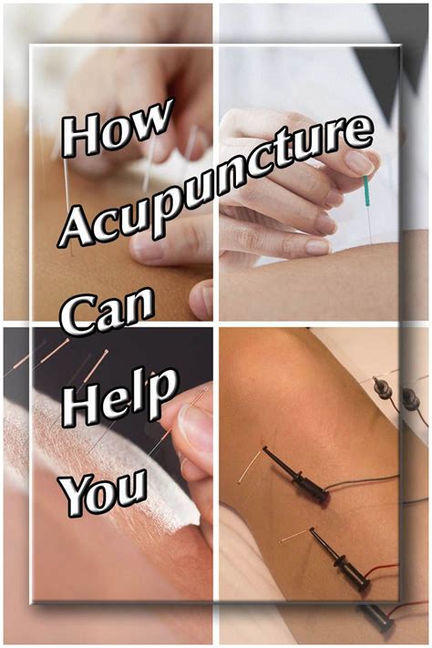 before scheduling a series of acupuncture treatments be sure your