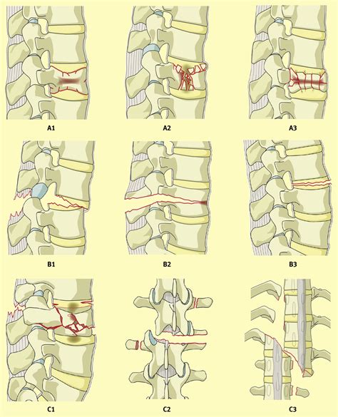 Ii Thoracolumbar Spinal Fractures Review Of Anatomy Biomechanics