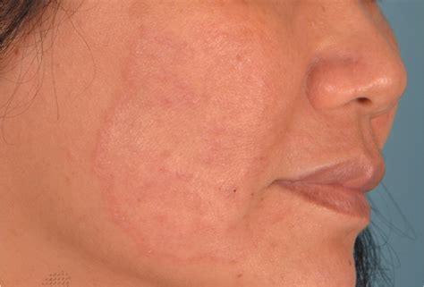 A Persistent Facial Rash Aafp