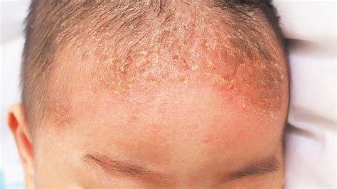 Minor Scalp Eczema