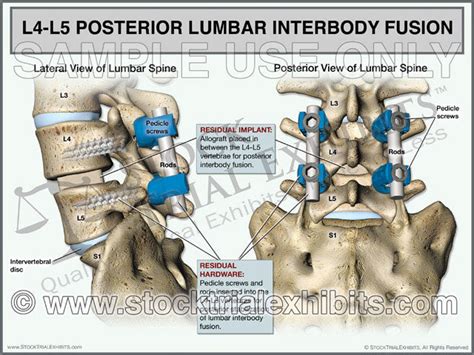 L4 L5 Posterior Lumbar Interbody Fusion Plif Stock Trial Exhibits