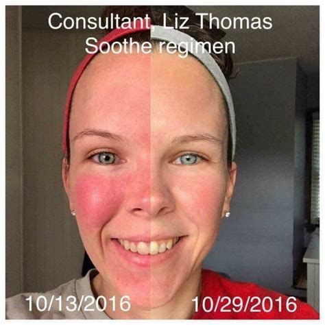 Looking To Get Rid Of Your Redness Rodan Fields Soothe Regimen Will