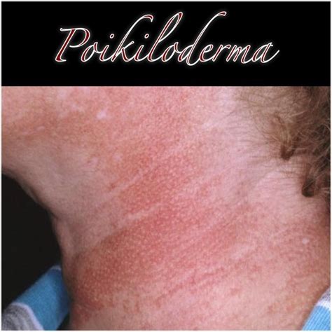 Poikiloderma Is Red Colored Pigment Commonly Seen On The Neck And