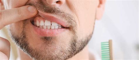 Itchy Gums Symptoms Causes And Treatment Implant Perio Center