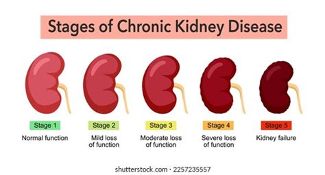 Stages Chronic Kidney Disease Infographic Concept Stock Vector Royalty