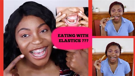 How To Eat With Braces Rubber Bands Reverasite