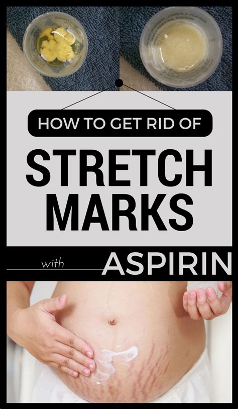 How To Get Rid Of Stretch Marks With Aspirin Stretch Marks Health