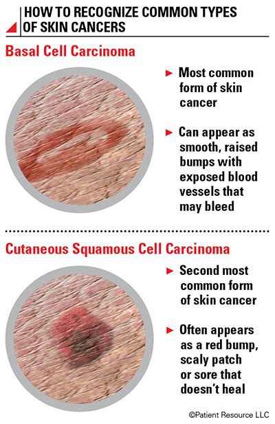 Skin Cancer Overview