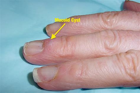 How Do I Get Rid Of A Mucous Cyst On My Finger Mastery Wiki