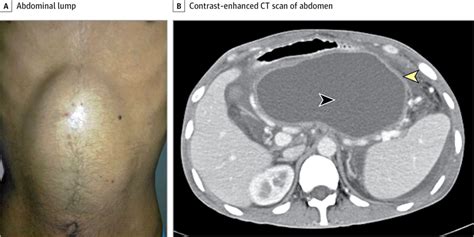 Young Adult With Abdominal Lump Adolescent Medicine Jama Surgery