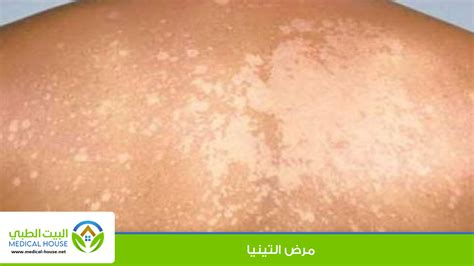 التينيا السعفة احد الامراض الفطرية الجلدية البيت الطبي الموسوعة