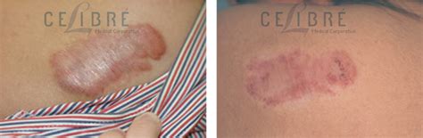 You may think that it is way cheaper than what you might have originally thought or heard about. Laser Scar Removal Cost California