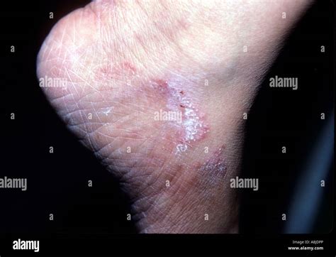 Fungal Infection Rash Tinea On Patients Ankle Stock Photo Alamy