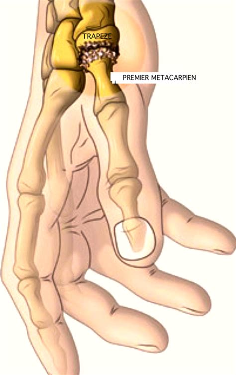 Rhizarthrose Arthrose De La Racine Du Pouce Chirurgien Specialiste Main