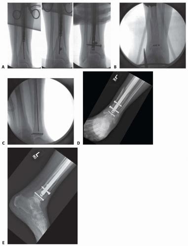 Intramedullary Nailing Of Metaphyseal Proximal And Distal Fractures