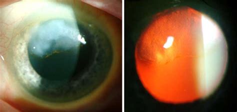 Salzmanns Nodular Corneal Degeneration The University Of Iowa