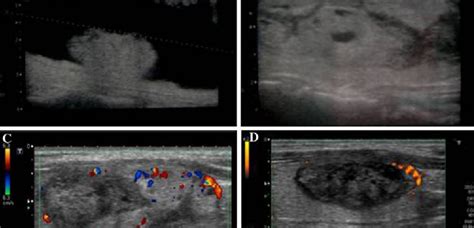 Use Of Radiofrequency Ablation For Benign Thyroid Nodules Boltz Research